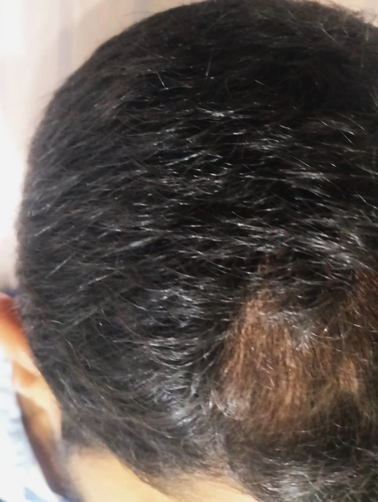 After alopecia hair treatment