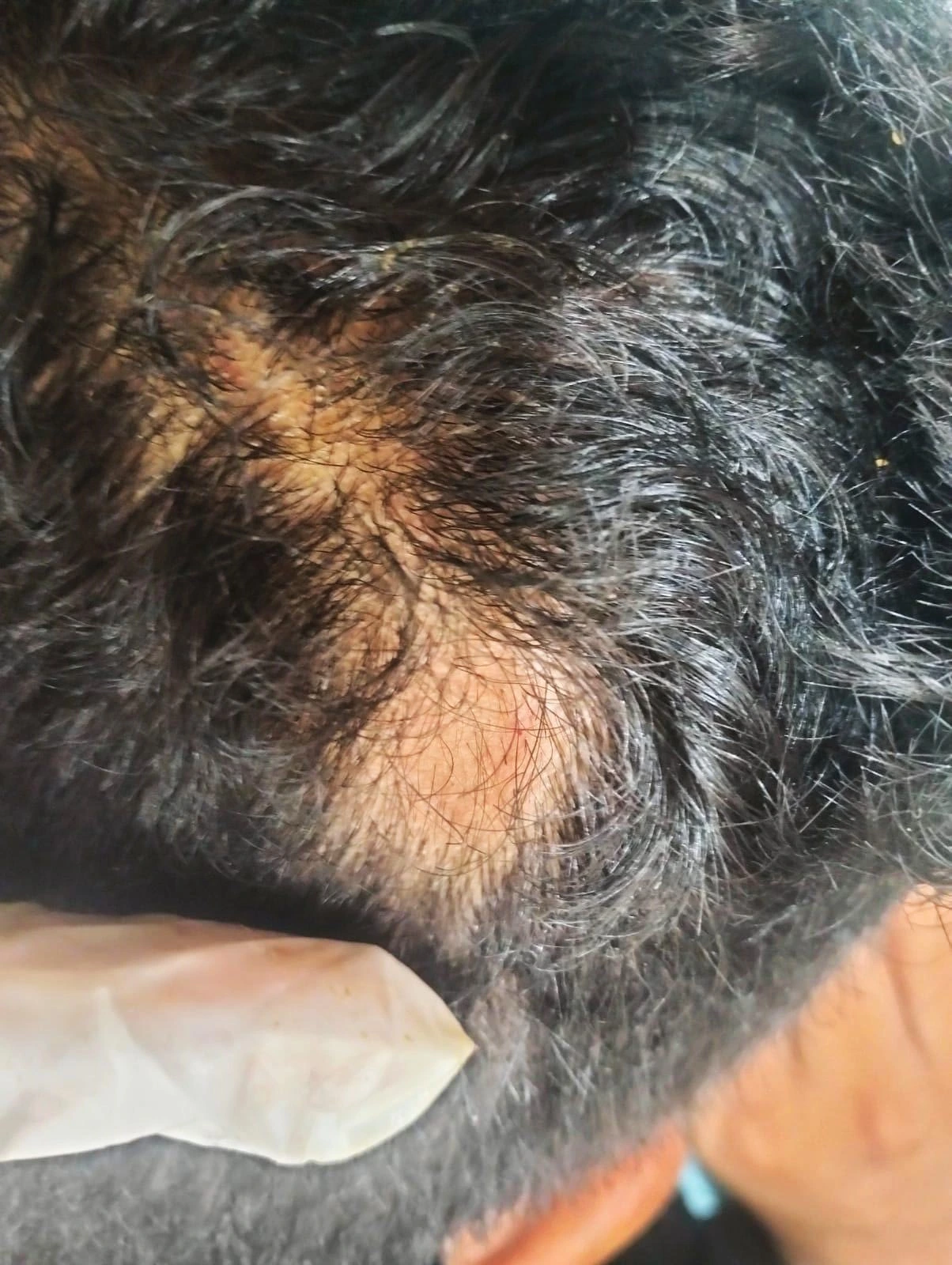Before alopecia hair treatment