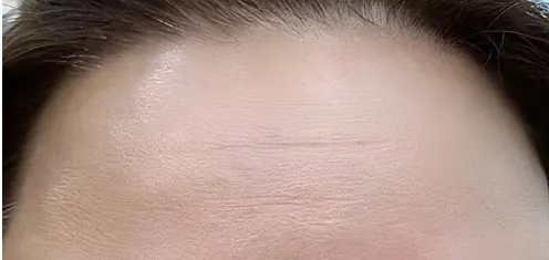 After anti-wrinkle treatment