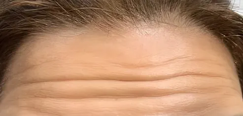 Before anti-wrinkle treatment