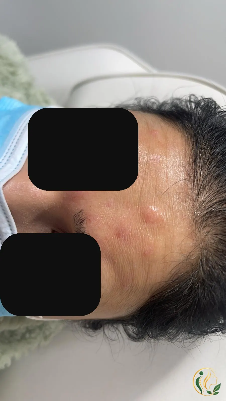 After forehead anti-wrinkle treatment