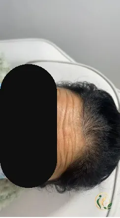 Before forehead anti-wrinkle treatment