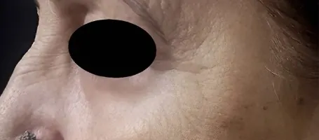 After under-eye rejuvenation