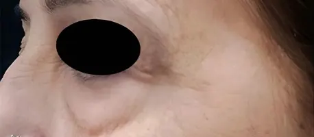 Before under-eye rejuvenation