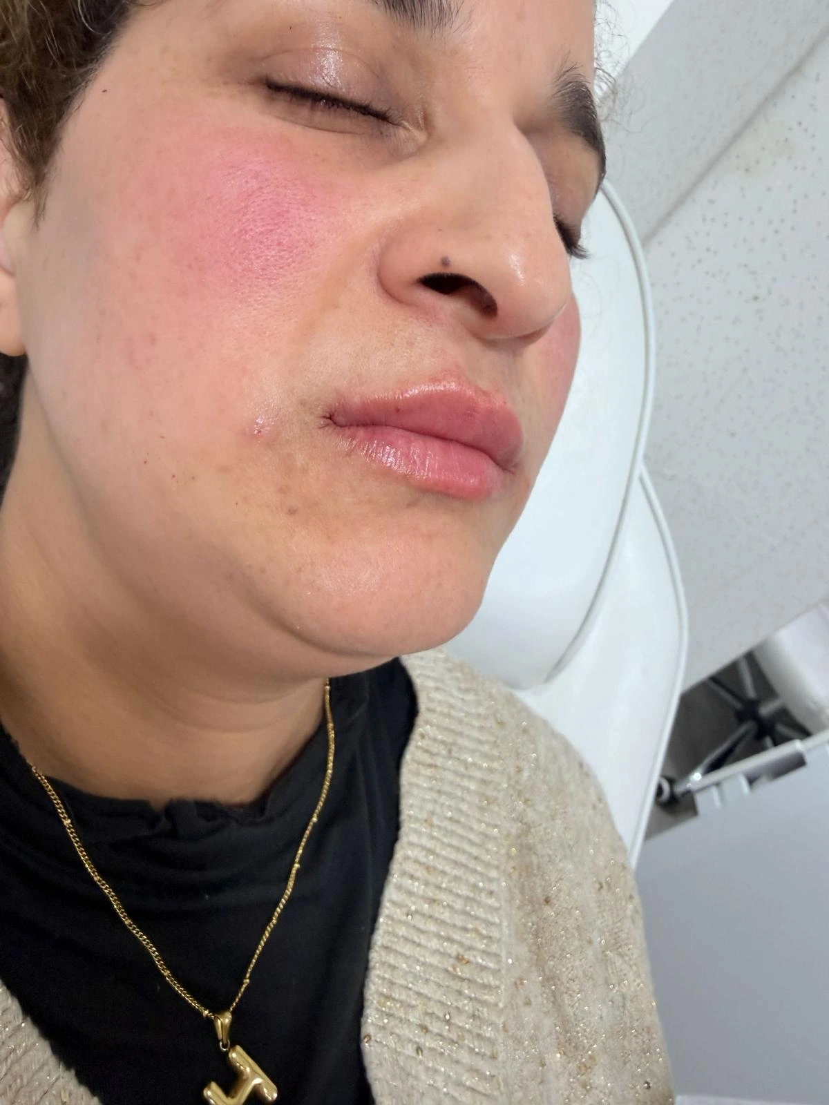 After Cheek Filler