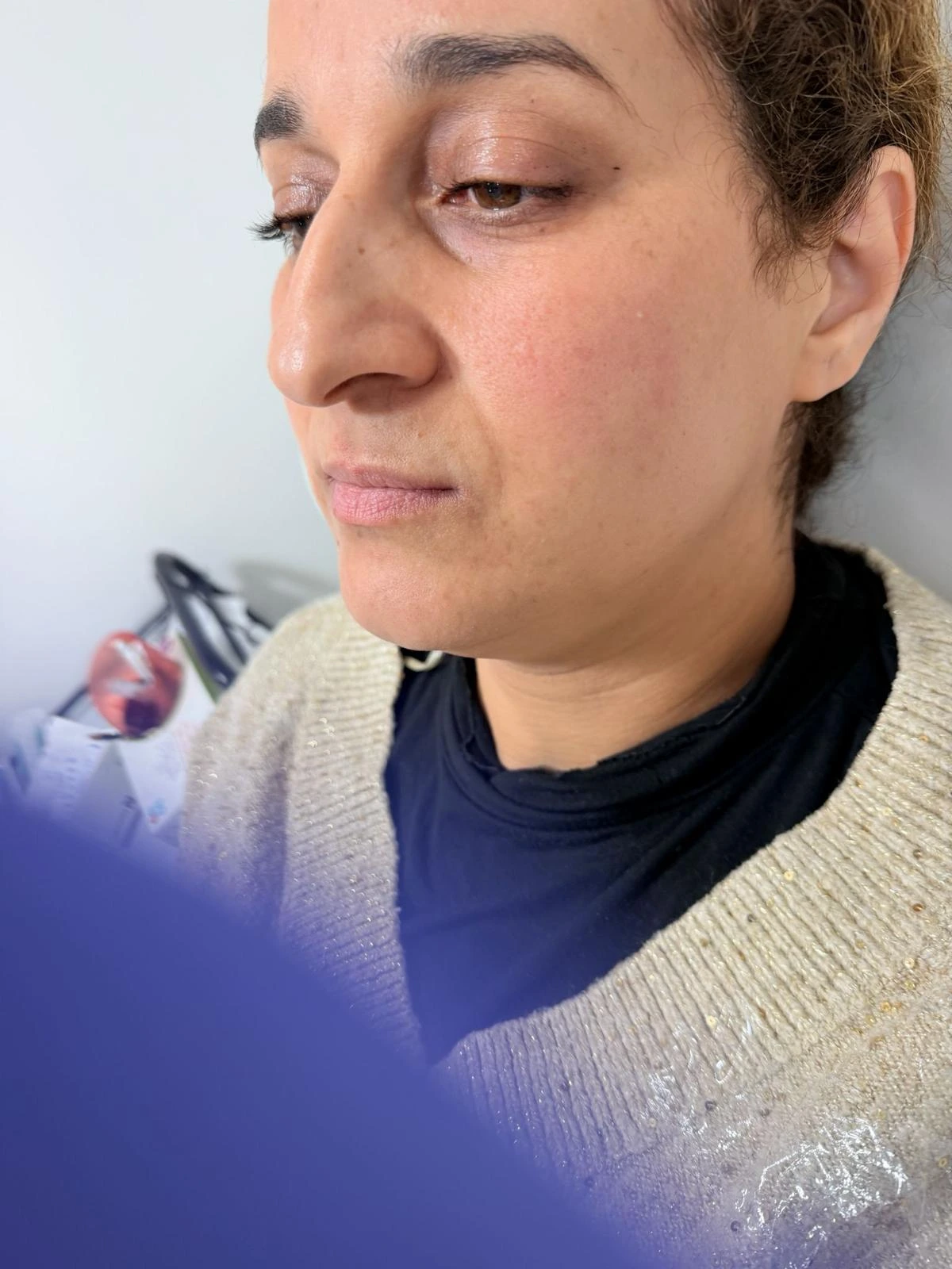 Before Cheek Filler