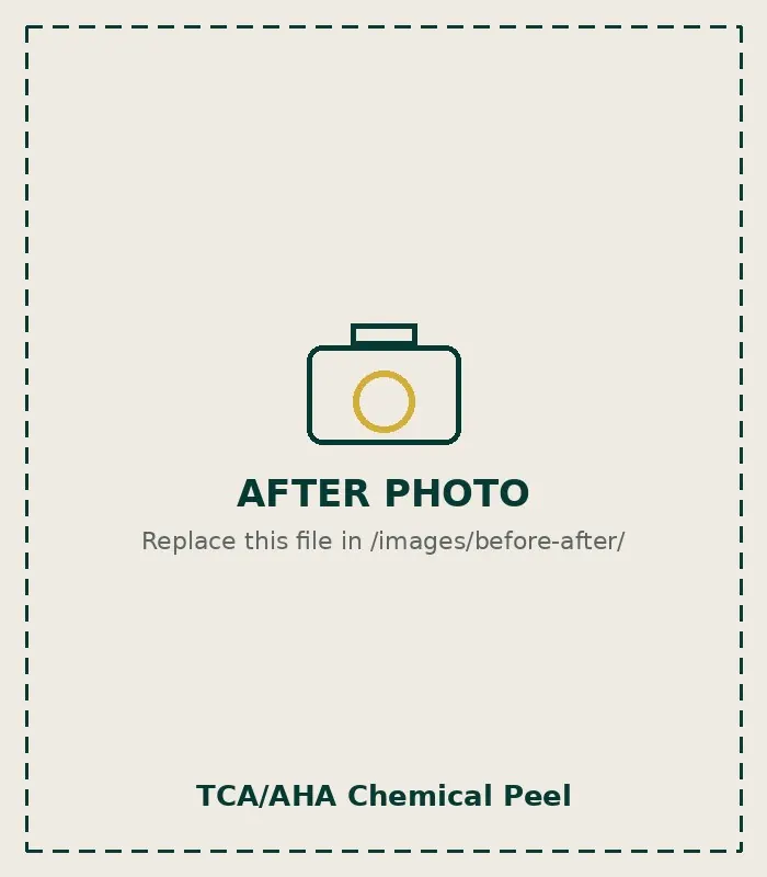 After TCA/AHA Chemical Peel