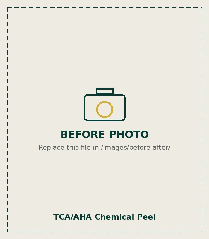Before TCA/AHA Chemical Peel