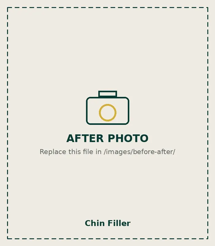 After Chin Filler