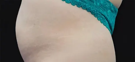 After fat transfer treatment