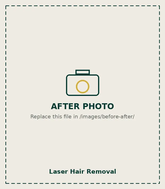 After Laser Hair Removal