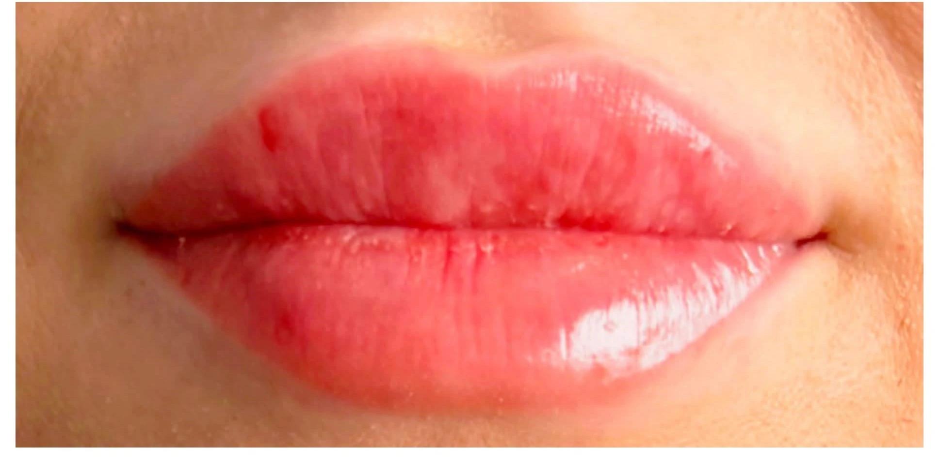 After Lip Filler