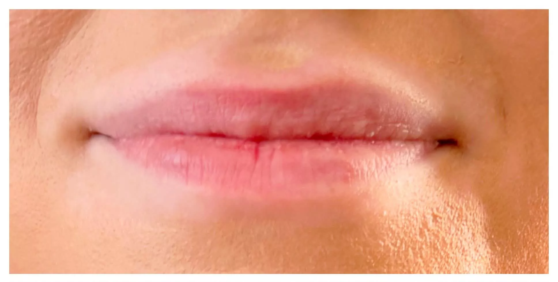 Before Lip Filler