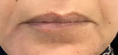 After marionette lines treatment