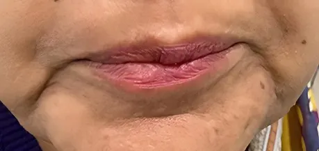 Before marionette lines treatment