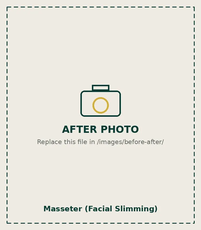 After Masseter (Facial Slimming)