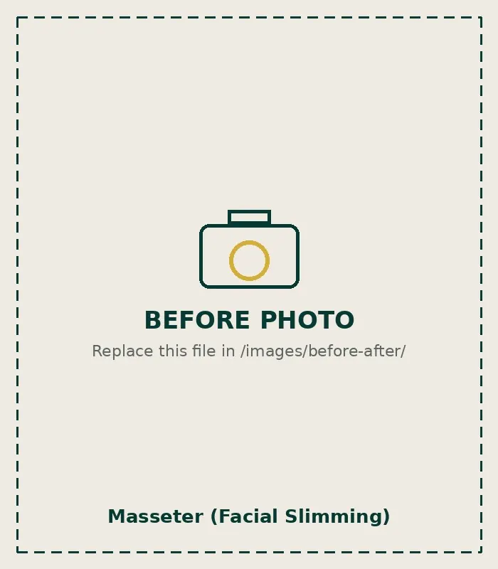 Before Masseter (Facial Slimming)
