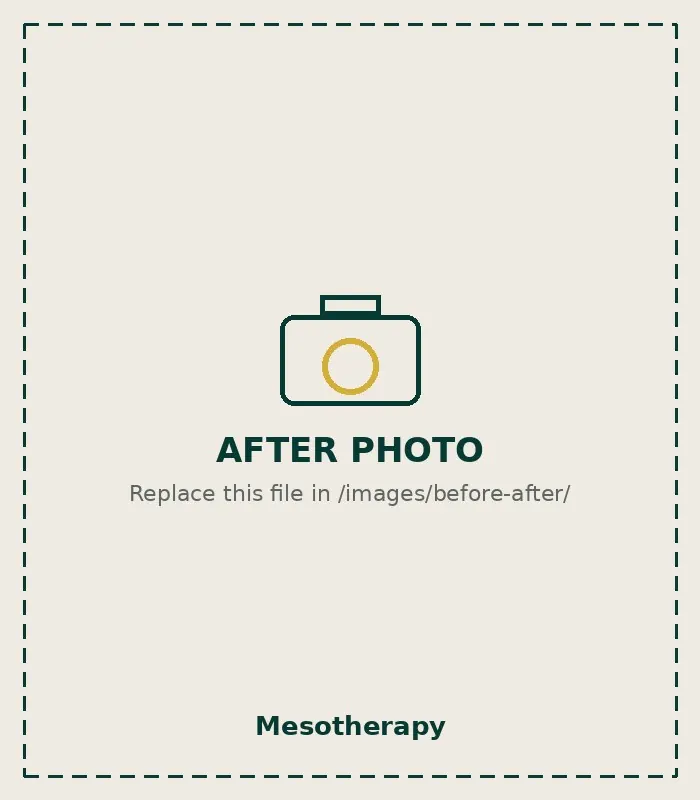 After Mesotherapy