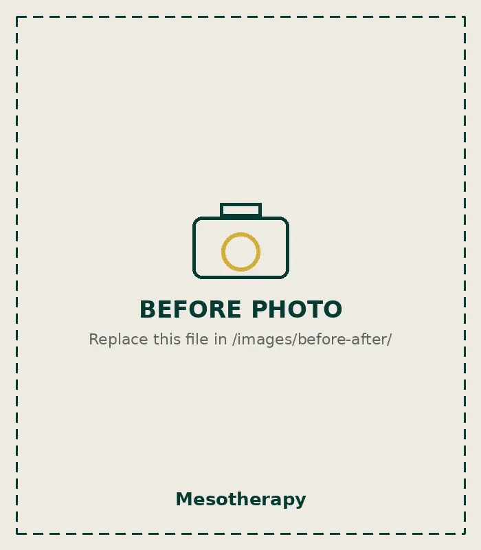 Before Mesotherapy