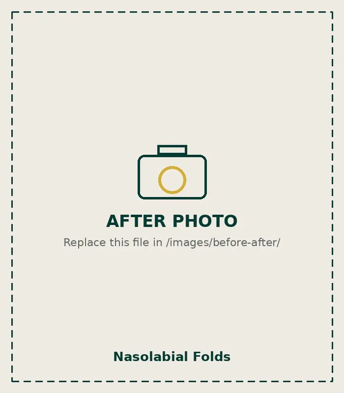 After Nasolabial Folds