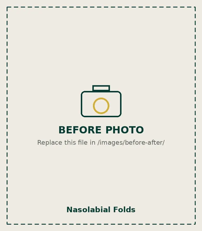 Before Nasolabial Folds
