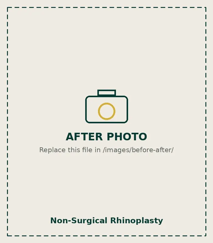 After Non-Surgical Rhinoplasty