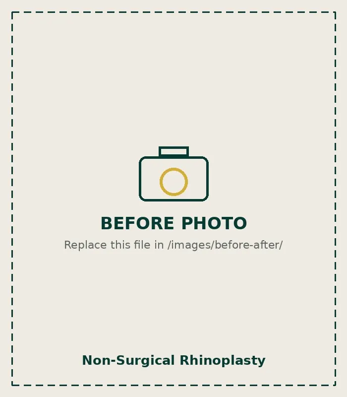 Before Non-Surgical Rhinoplasty