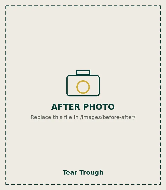 After Tear Trough