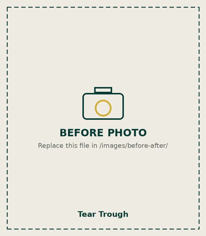Before Tear Trough